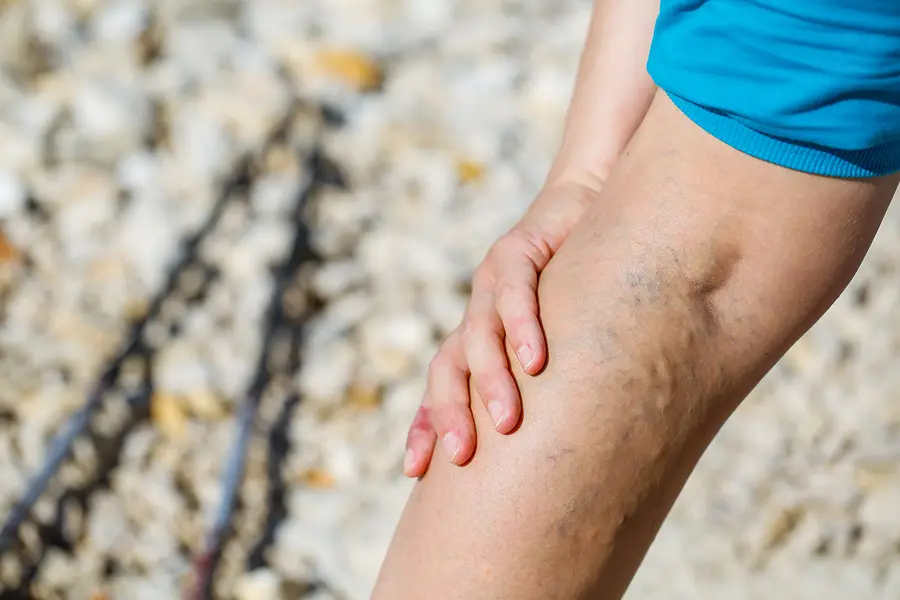 Woman wearing a dress with varicose veins on her legs, set against a blurred background