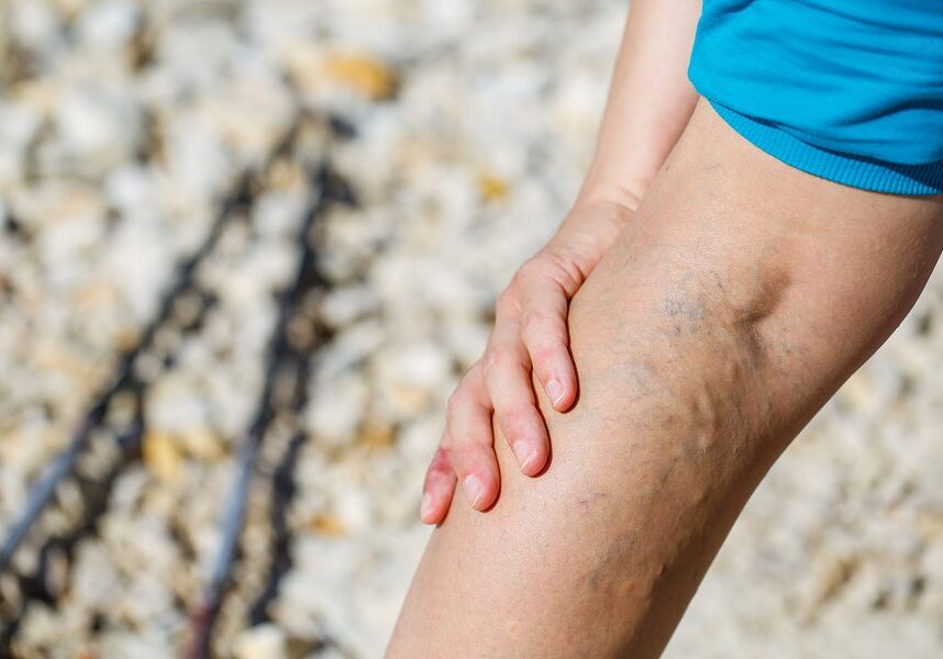 Woman wearing a dress with varicose veins on her legs, set against a blurred background
